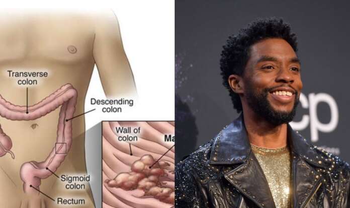 Causes, Methods, And Prevention Of Colon Cancer Which killed Chadwick Boseman (Black Panther)