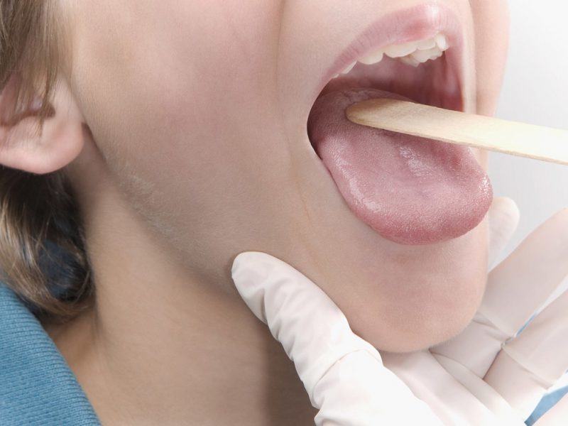 Mononucleosis